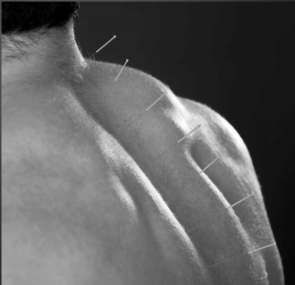 man-having-acupuncture